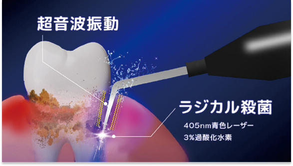 ブルーラジカル治療の仕組み1