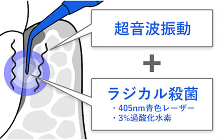 ブルーラジカル治療