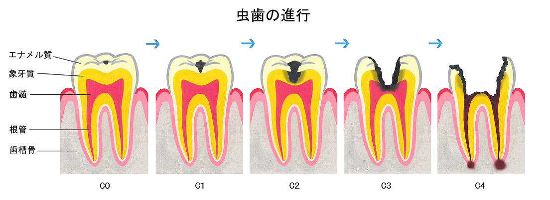 虫歯の進行段階