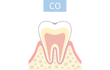 CO段階の虫歯