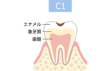 C1段階の虫歯