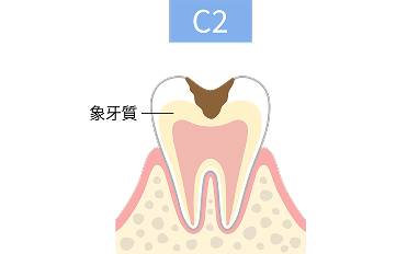C2段階の虫歯