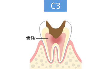 C3段階の虫歯