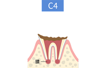 C4段階の虫歯