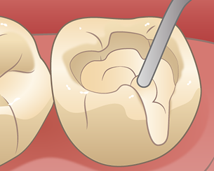コンポジットレジン使用