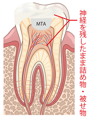 MTAセメント