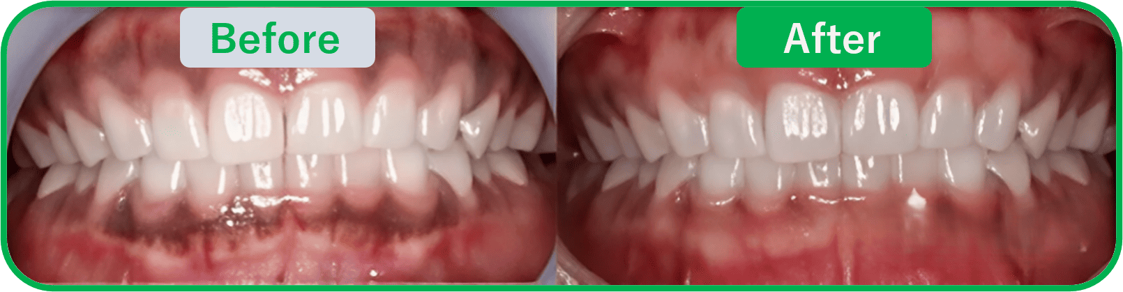 ジルコニアセラミック写真