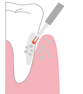 歯肉縁下歯石の除去