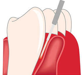 歯周ポケット内の殺菌