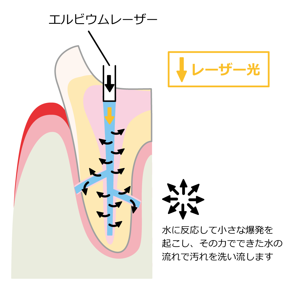 エルビウムヤグレーザー特徴