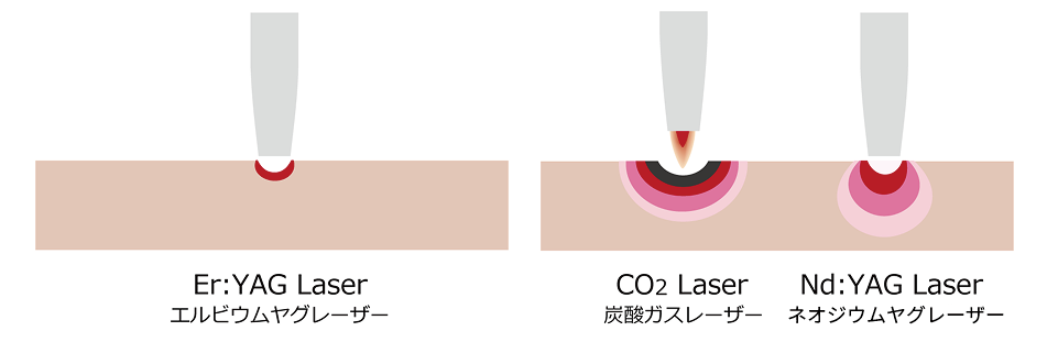 身体に負担がかからない歯周病治療