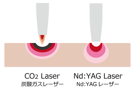 身体に負担がかからない歯周病治療 2