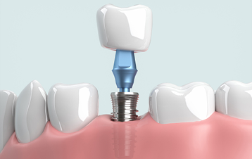 上部構造の取り付け