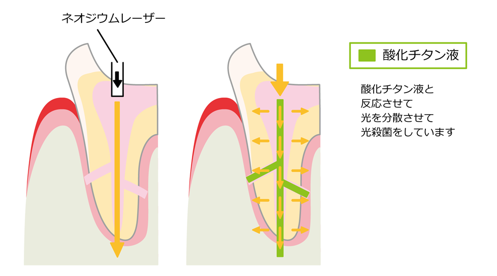 ネオジウムヤグレーザー写真