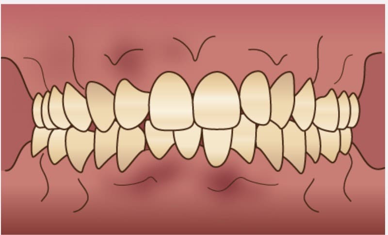 歯茎の黒ずみ、色素沈着を除去