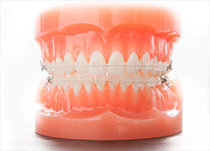 部分的なブラケット装置