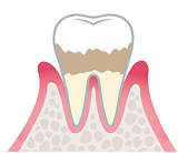 初期歯周炎