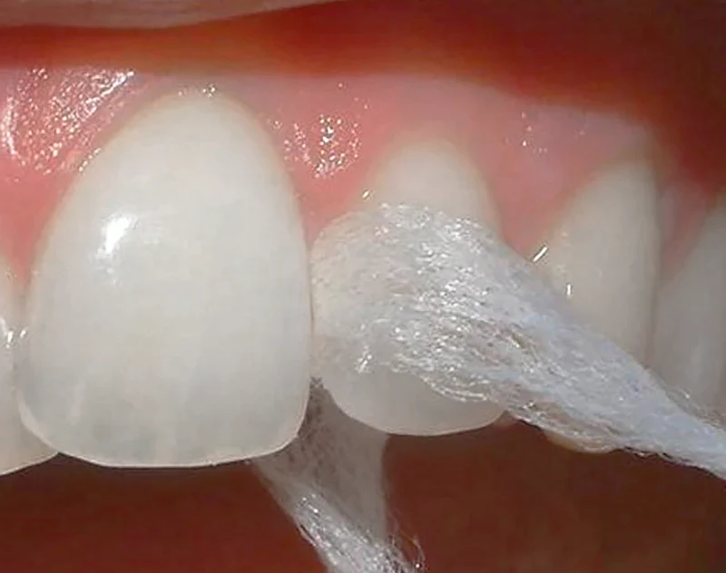 デンタルフロス指導