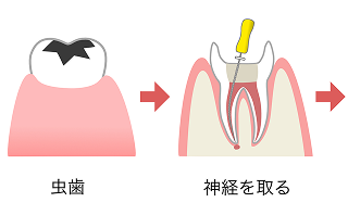 根管治療の流れ モバイル 1
