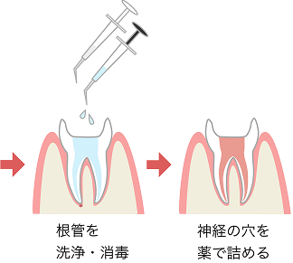 根管治療の流れ モバイル 2
