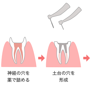 根管治療の流れ モバイル 3