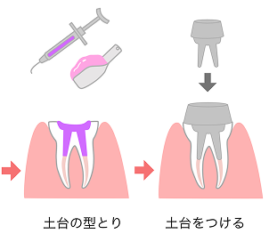 根管治療の流れ モバイル 4