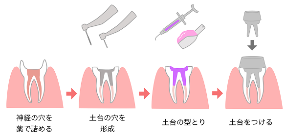 根管治療の流れ 下部