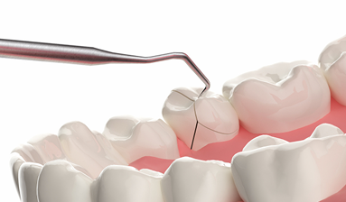 根管治療は歯を抜かずに保存できる治療法