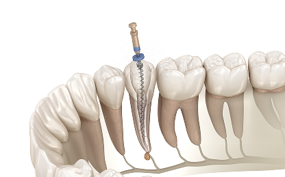 根管治療のデメリット