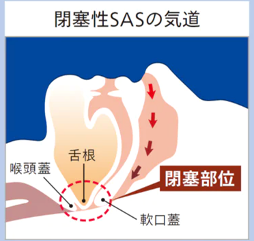 閉塞性SASの気道