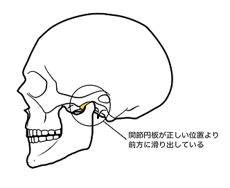 顎関節症について2