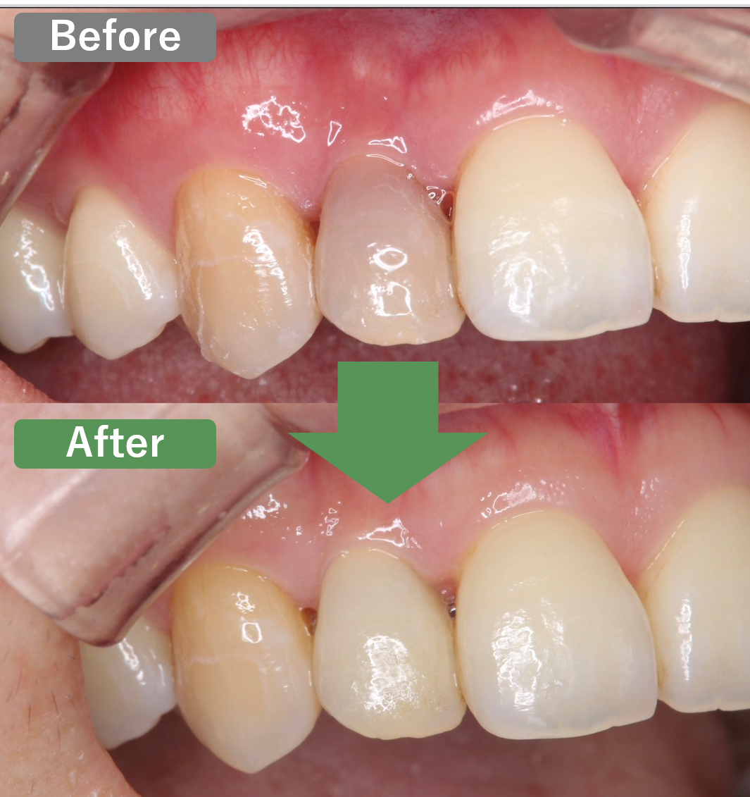 神経がない歯のホワイトニング