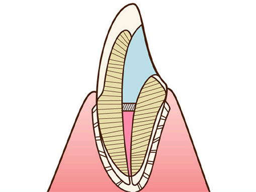 ウォーキングブリーチの方法