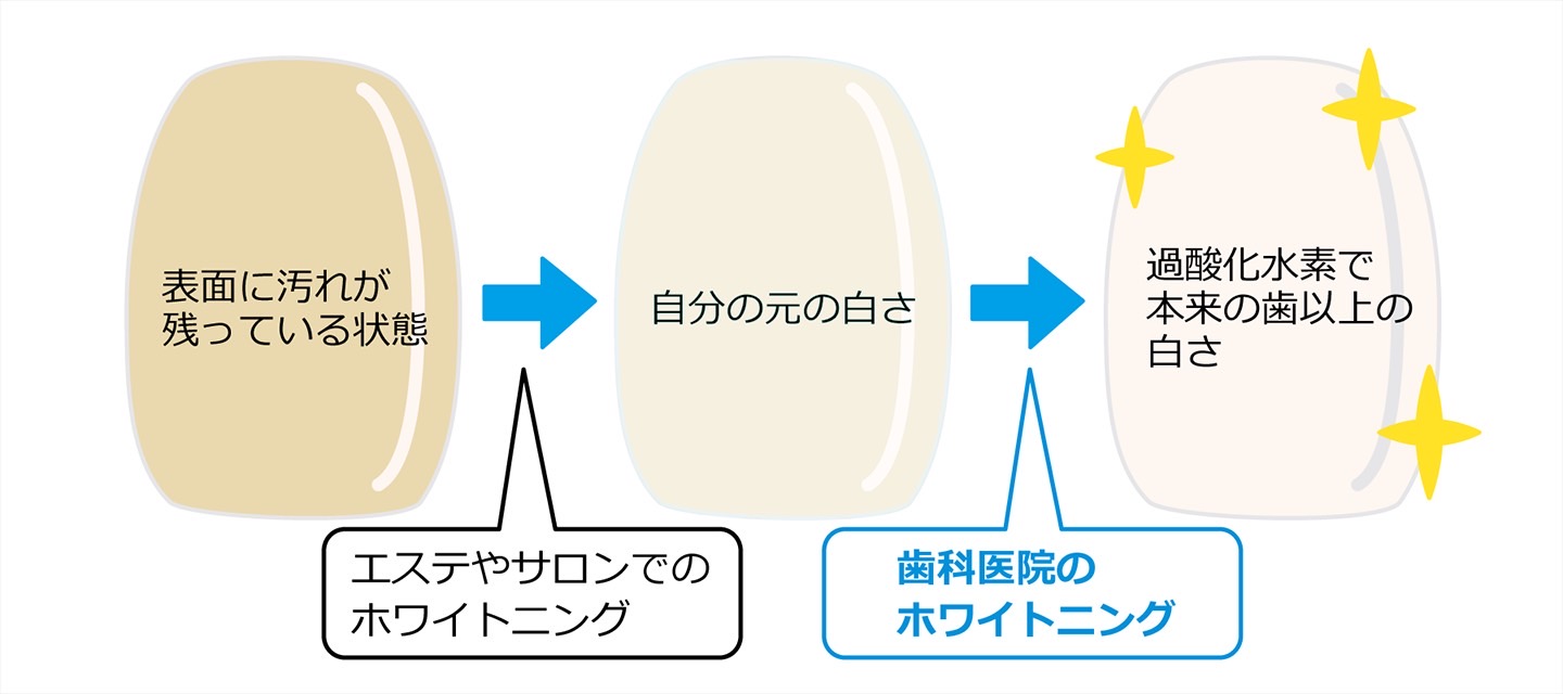 ホワイトニングの違いフローチャート