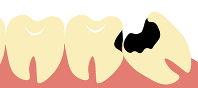親知らずの影響