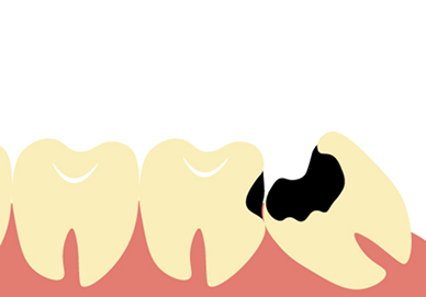 親知らずの影響